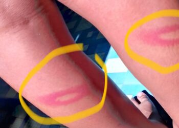 Murid SMPN 3 Bunta Diduga di Pukul Guru Hingga Lebam, Wali Murid Kecam Pihak Sekolah